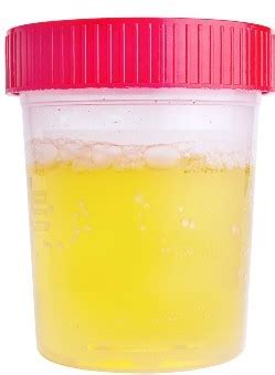 How to keep the symptoms of protein in urine for children - nyforall
