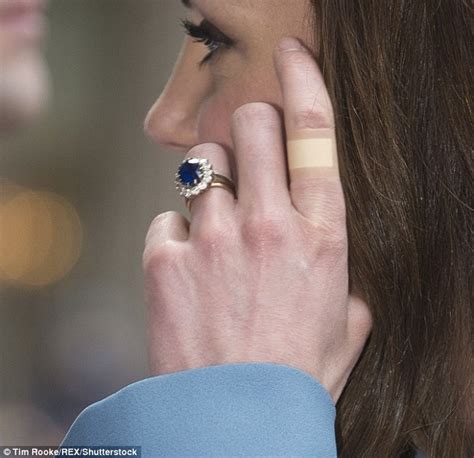 Kate Middletons Catalogue Of Injuries To Her Perfectly Manicured