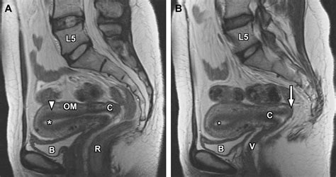 Normal And Variant Pelvic Anatomy On MRI Magnetic Resonance Imaging Clinics