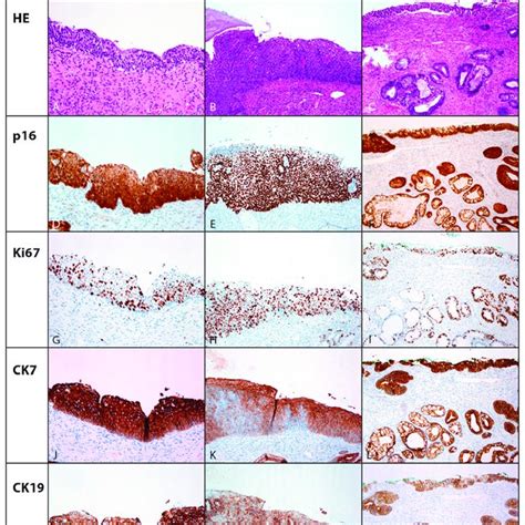 Immunohistochemical Expression Of P16 Ki67 Ck7 And Ck19 In Stratified