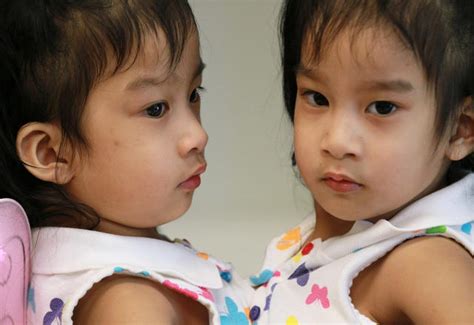 Formerly Conjoined Twins Thrive Separately