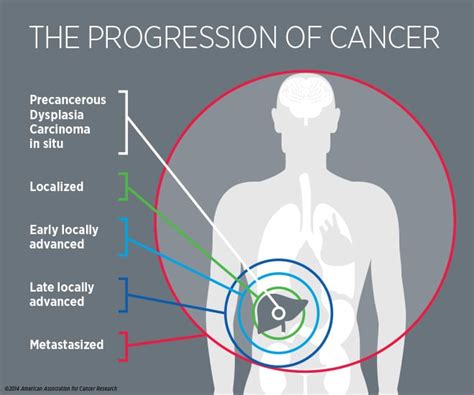 What Is Cancer Patients And Caregivers Aacr