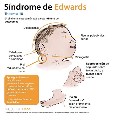 Características Da Síndrome De Edwards