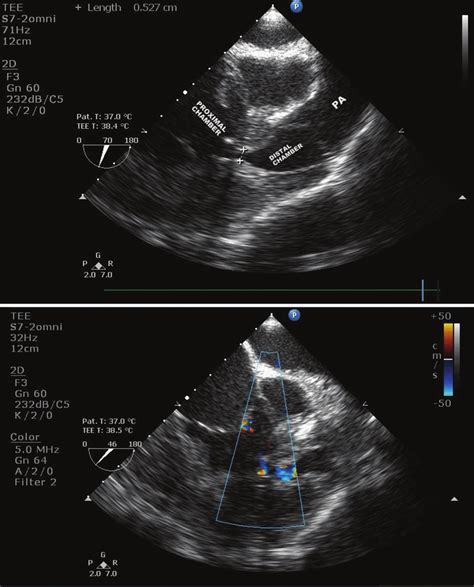 A Two Dimensional Transesophageal Echocardiography Mid Esophageal