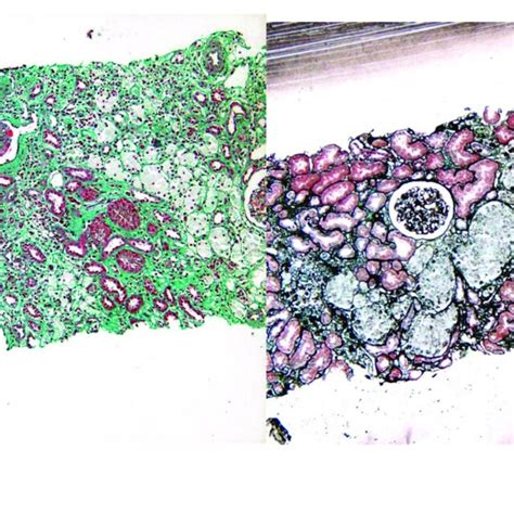 The Light Microscopy Images Of The Renal Biopsy A Masson Staining