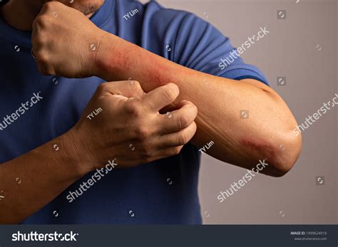 7140 Hand Dermatitis Patient Images Stock Photos And Vectors Shutterstock