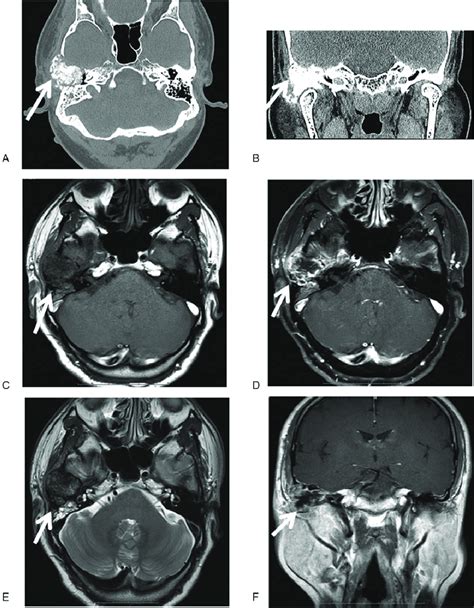 Temporal Bone Ct Scan And Mri Results Of The Cmf Patient A Ct Axial