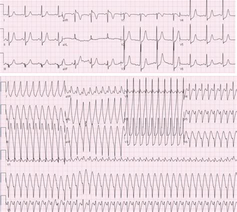 Both in patients with psvt and paf, an attack of psvt or paf could be documented by ecg in more than 70% of the calls when patients complained of tachycardia, increased sweating, or dyspnea. jack119.org: WPW Syndrome