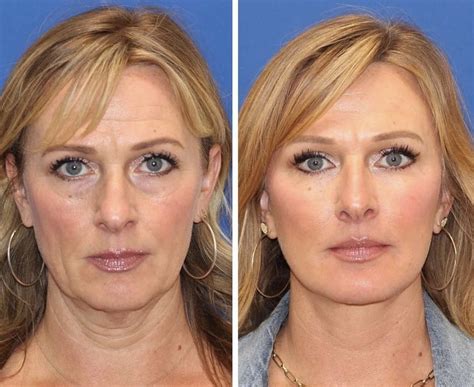 The Cosmetic Lane On Twitter Years Post Full Facial Rejuvenation Procedures Performed