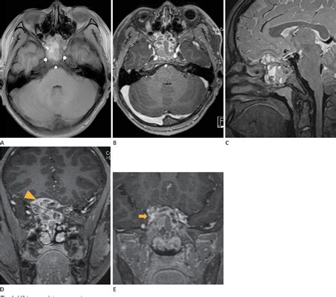Figure 2 From Chondroblastoma With Secondary Aneurysmal Bone Cyst In