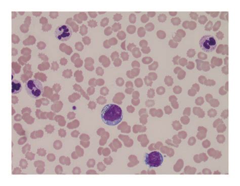 Peripheral Blood Examination A The Patients Peripheral Blood Smear