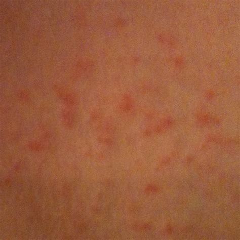Skin Rashes On Arms
