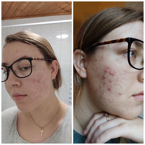 Acne Bro Differin Works ~6 Weeks On Differin And Lymecycline This