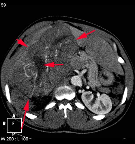 Clinical Cases Abdomen And Pelvis Woman 34 Years Old Abdominal Pain