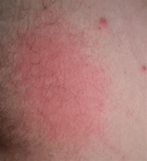 I Appear To Have Developed A Burning Rash In The Groin Area I Can Only