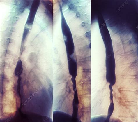 Stent To Treat Aortic Stenosis X Ray Stock Image C0041456