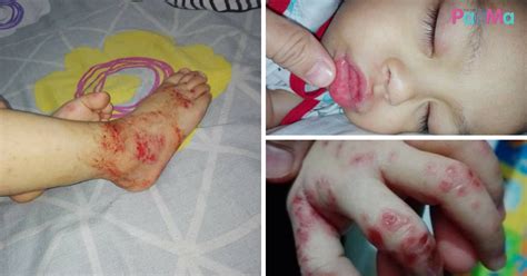 Coxsackievirus infections can spread from person to person. "Dalam Masa 2 Hari Boleh Jadi Teruk Macam Ni". Si Kecil ...