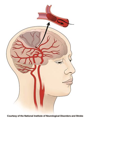 Without blood and the oxygen it carries, part of the brain starts to die. Ischemic Stroke | Illustration of an ischemic stroke ...