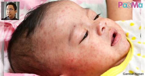 Chickenpox is a highly contagious viral infection that causes an acute fever and blistered rash , mainly in children. Measles Boleh Akibatkan Maut & Bengkak Otak. Ia Bukan ...