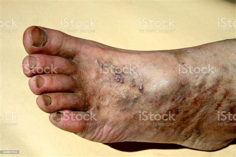 Varicose Veins Thrombosis Foot Extension Of Veins On The Leg Stock
