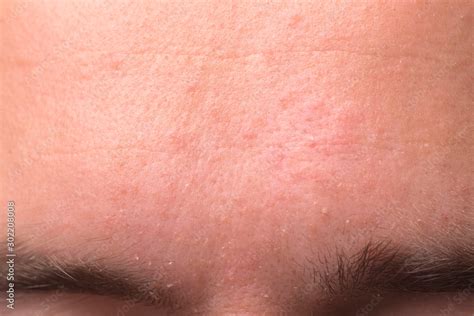 Weeping Eczema In The Stage Of Exudation Closeup Of Forehead Area With