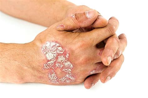 Psoriasis Is More Than Skin Deep The Star