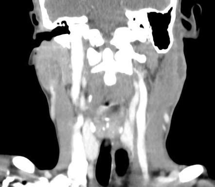 Subcutaneous Abscess Radiology Reference Article Radiopaedia Org