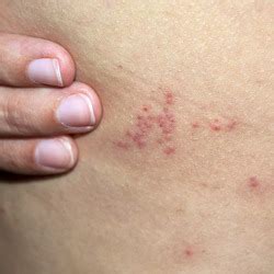 Die meisten stiche im bett lassen sich relativ schnell und eindeutig zuordnen weil sie entsprechende beobachtungen machen zum beispiel das stiche im bett. Bettwanzenstich - Gräser im kübel überwintern