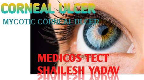 Mycotic Corneal Ulcer Youtube