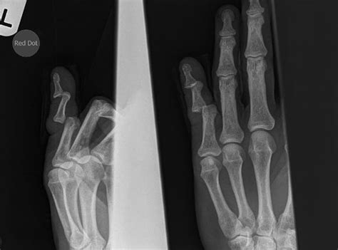 Double Dislocation Of Finger Interphalangeal Joints Bmj Case Reports