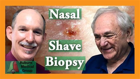 American medical group has locations in both hobbs and carlsbad, nm. Nose Shave Biopsy | Auburn Medical Group - YouTube