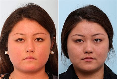 Buccal Fat Pad Removal Photos Houston Tx Patient 27845