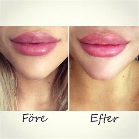 Pin On Lip Fillers