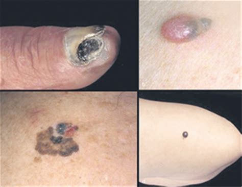 Das melanom ist ein von melanozyten ausgehender, maligner tumor, der ganz überwiegend in der haut entsteht. Hautkrebs? Bitte genau hingucken!