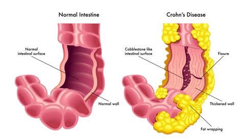Crohn’s Disease Sexuality In Chronic Illness Fa 20