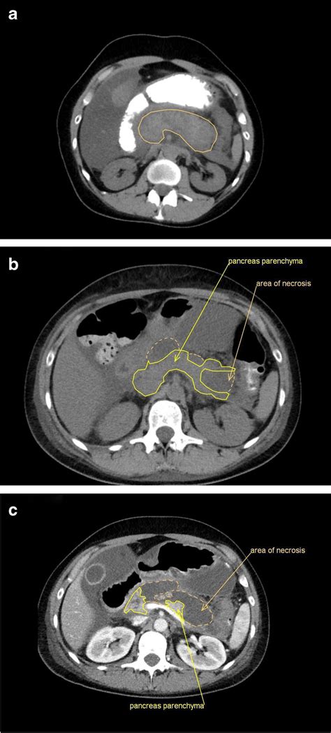 A Native Abdominal Ct Scan With Oral Contrast Dye At The Day Of
