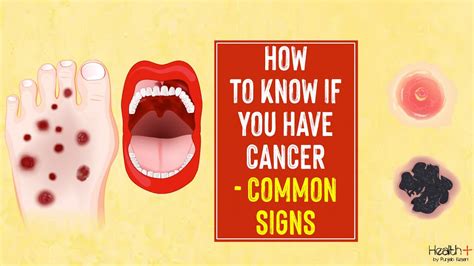 How To Know If You Have Cancer Common Signs Youtube