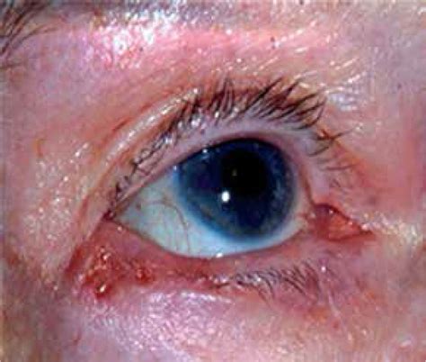 Identifying Predictive Morphologic Features Of Malignancy In Eyelid