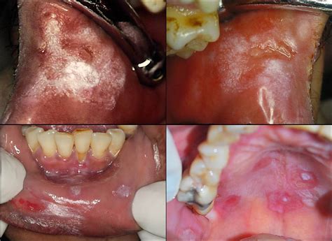 The main risk factor for the formation of skin vesicles (vesicular eruptions) is trauma (for example, eyelash epilation, chemical eye burns, prosthetics, and damage to oral mucosa with a toothbrush or. Oral Manifestations of Secondary Syphilis - International ...