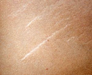 Check spelling or type a new query. Narben entfernen mit Laser - Narbenkorrektur | info Medizin
