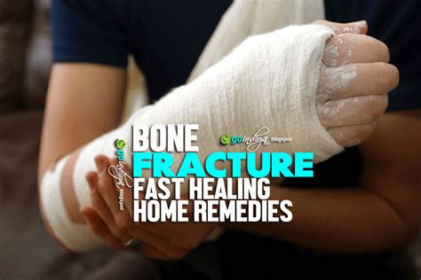 Bone Fracture Heal Broken Bone Faster With Home Remedies Natural