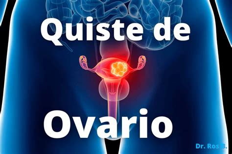 Quistes De Ovario Diagnóstico Y Tratamiento Dr Ros Berruezo Ginecólogo Reproducción Asistida