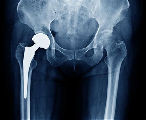 Total Hip Replacement Empower Medicare Supplements