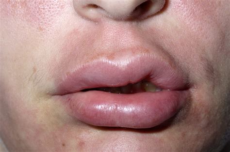 Lip Biting Meaning Causes Symptoms Images Bumps Swollen Lip From