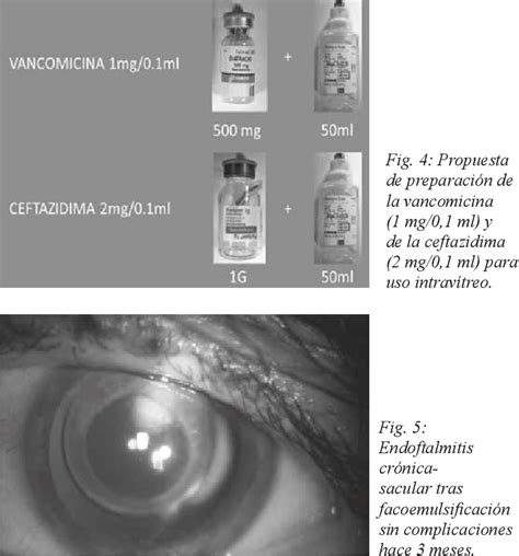 Actualizaci N En La Prevenci N Y Tratamiento De La Endoftalmitis