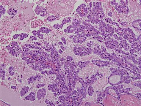 6 Salivary Glands Epithelial Myoepithelial Tumors Ma Flickr