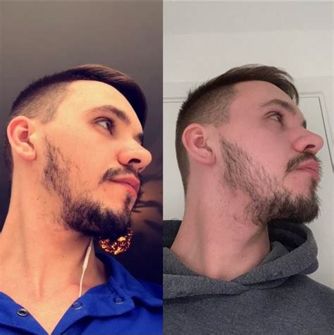 As a side effect hair growth was identified. Minoxidil Before And After Beard Result : The Struggle to Grow a Beard Is Real. So Men Are ...