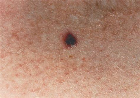 Skin Cancer Melanoma Treatment Causes Stages Early Si