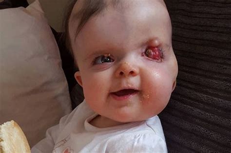 By imelda green 6 years ago. Baby girl born with misshapen skull and 'one eye' branded ...