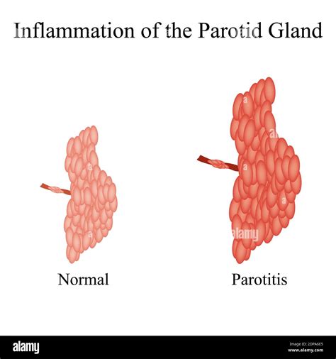 Inflamación De La Glándula Parótidala Estructura De La Glándula